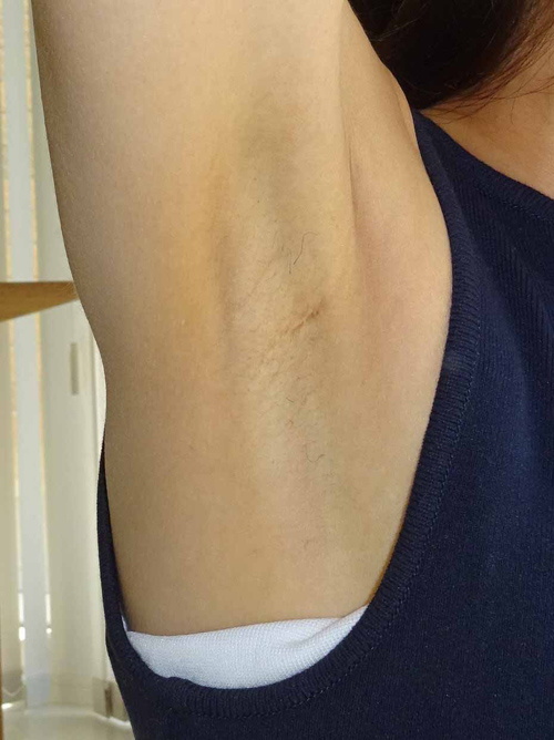 3回目の脱毛お手入れ前のワキ